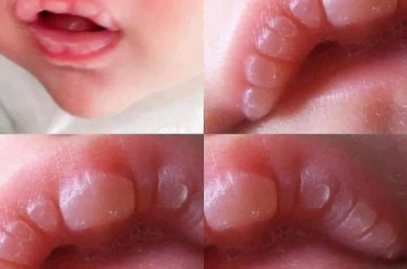 ما هي فقاعة الرضاعة [Lip Blister ]وكيف تتعاملين معها !